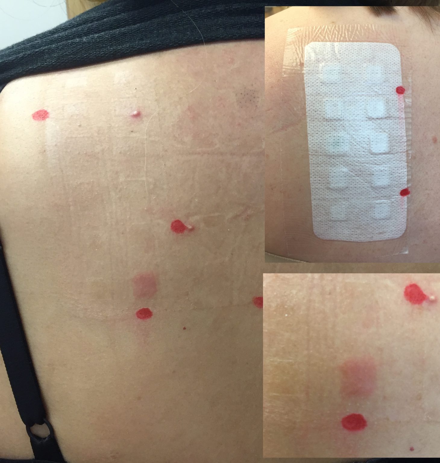 Allergy Testing Allergy Center of Connecticut